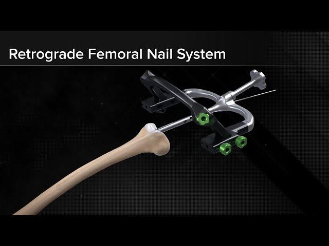 Retrograde Femoral Nail System Surgical Technique