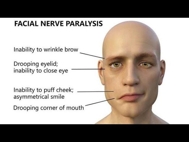 Research Links Covid-19 Vaccines to Facial Paralysis