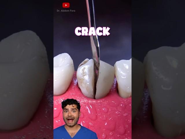 Cracked Tooth !?