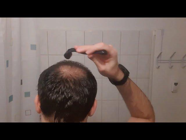 Minoxidil + Derma Roller Results I 4 Months Update