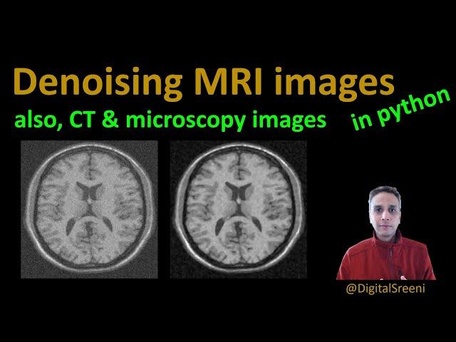 94 - Denoising MRI images (also CT & microscopy images)