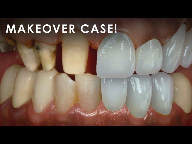 How a Dental Lab Fabricates a Makeover Case