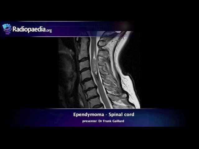 Spinal ependymoma - radiology video tutorial (MRI)