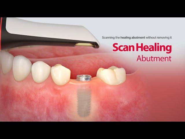 Able to scans the healing abutment without removing it : “Scan Healing Abutment”