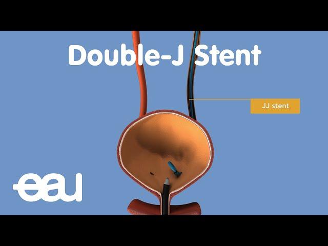 JJ Stent (removal of kidney stones)