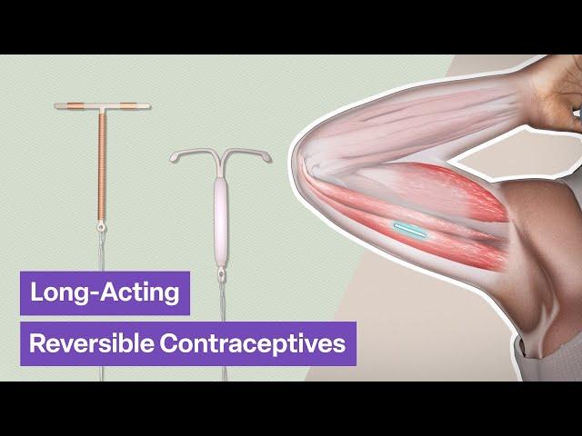 Long-Acting Reversible Contraceptives (LARCs) | TVASurg