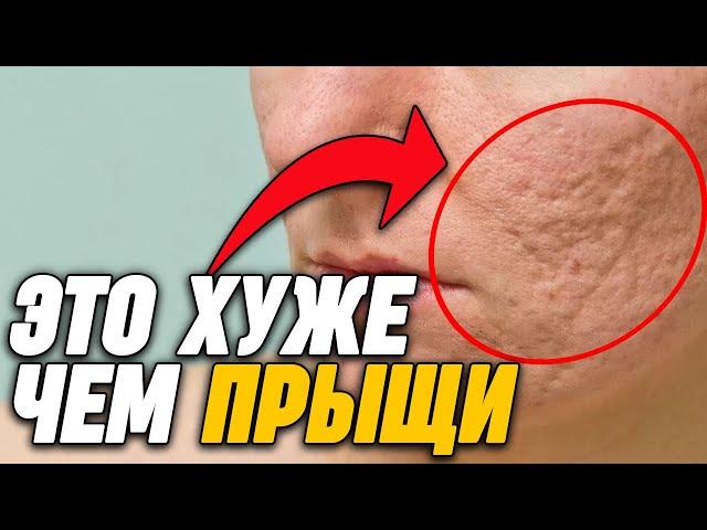 4 Вещи Которые ХУЖЕ Чем Прыщи!