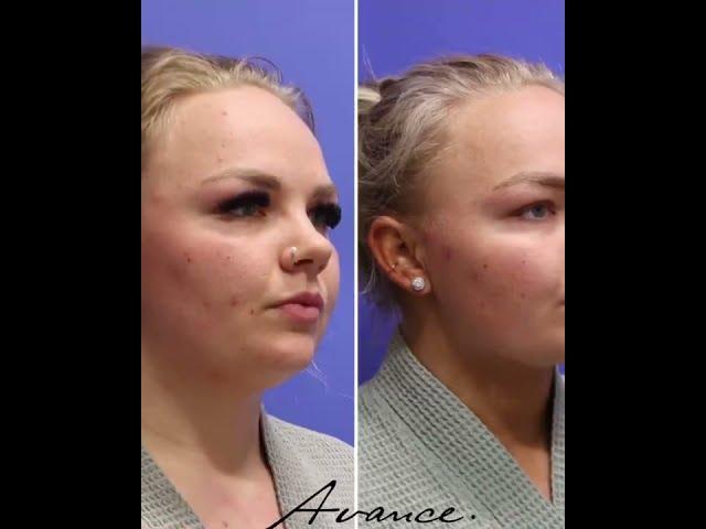 Reno NV Neck Liposuction with FaceTite | Neck Lipo Before & After | Avance Plastic Surgery Institute