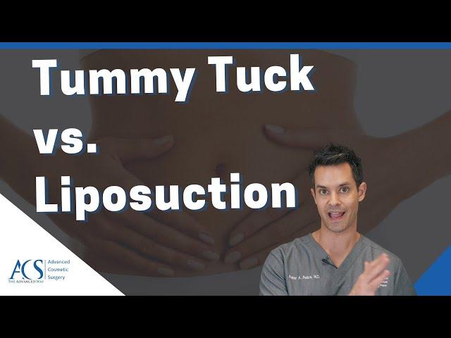 Liposuction and Tummy Tuck Surgery: Differences, Cost, Recovery & Results