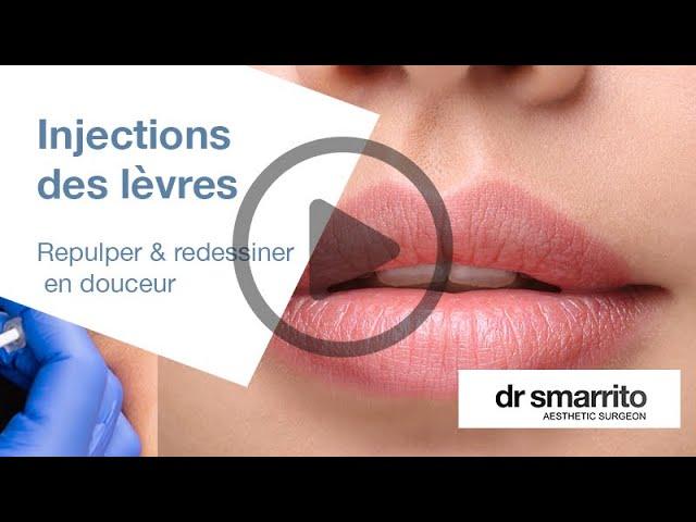 Injection d'acide hyaluronique : Injection des lèvres et rhinoplastie médicale : la profiloplastie.