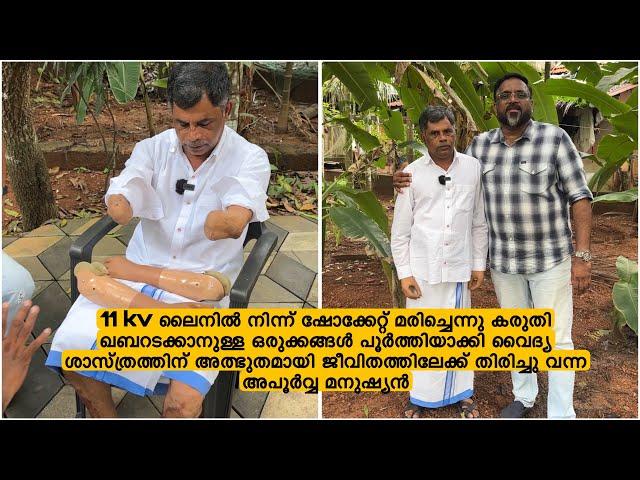 11 kv ലൈനിൽ നിന്ന് ഷോക്കേറ്റ്‌ മരിച്ചെന്നു കരുതി ജീവിതത്തിലേക്ക് തിരിച്ചു വന്ന അപൂർവ്വ മനുഷ്യൻ