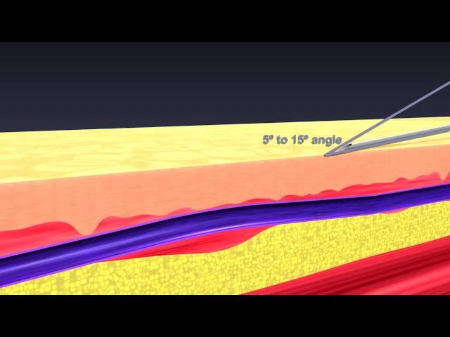 Administering Intradermal Injections