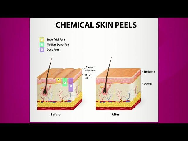 Chemical Peel: Purpose & Types