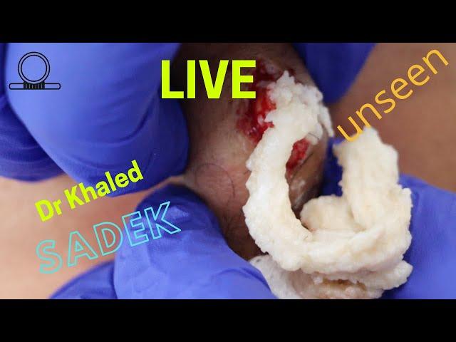 Multiple Cyst Removal Part 2. Dr Khaled Sadek. LipomaCyst.com