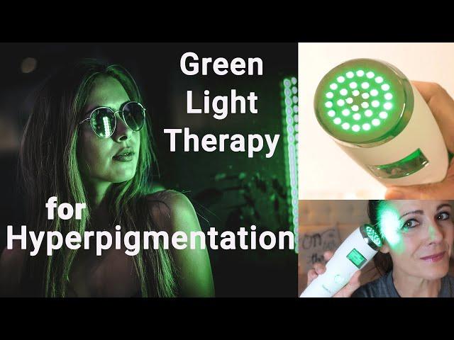 Green Light Therapy for Hyperpigmentation