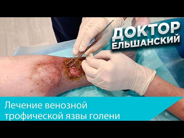 Лечение венозной трофической язвы (Venous ulcer treatment)