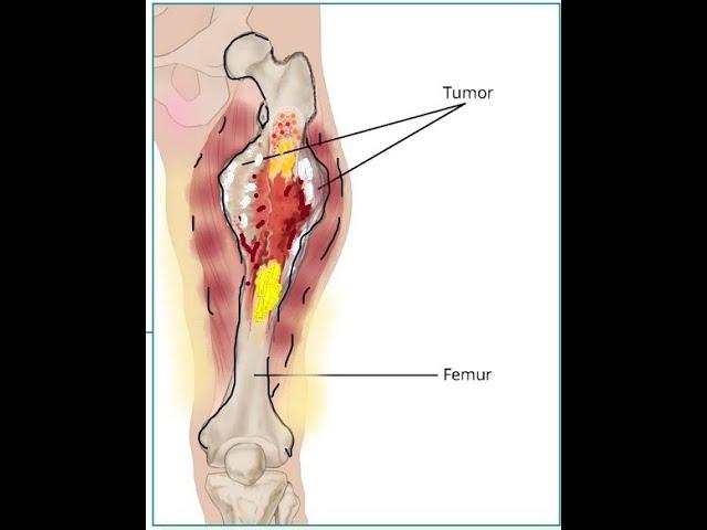 Ewing’s  Sarcoma