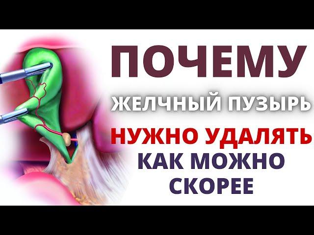 Почему нужно удалять желчный пузырь как можно скорее! Нашли камень в желчном пузыре - что делать?