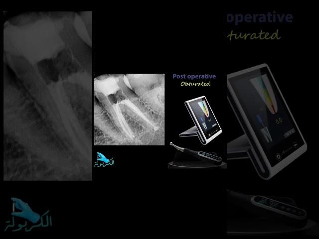 broken file bypass at the Apical 3rd