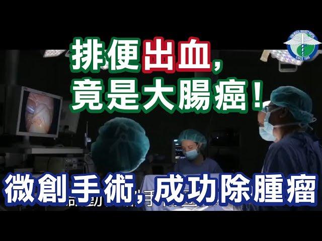 微創手術-微創腹腔鏡自然孔手術