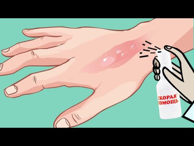 Первая помощь при ожогах, укусах и ссадинах.
