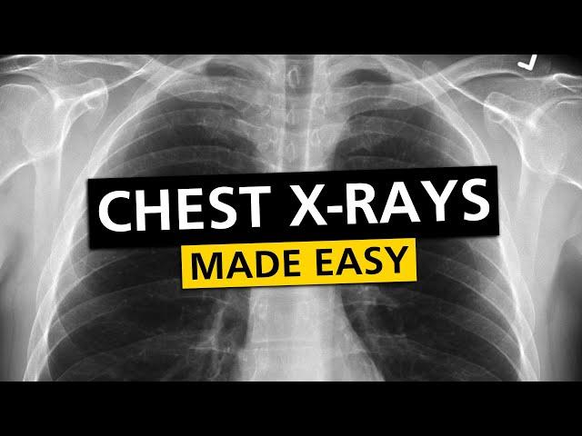 Chest X Rays (CXR) Made Easy! - Learn in 10 Minutes!