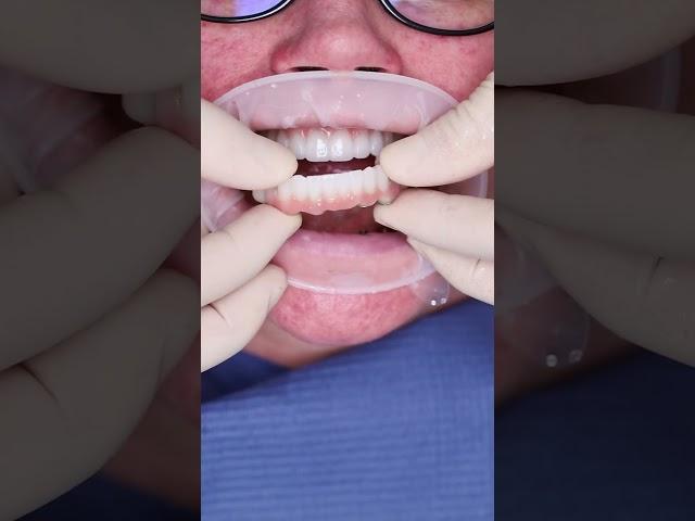 Dental implant’s All on 4 in Prague #shorts #dentist #dental #implant #veneers #short