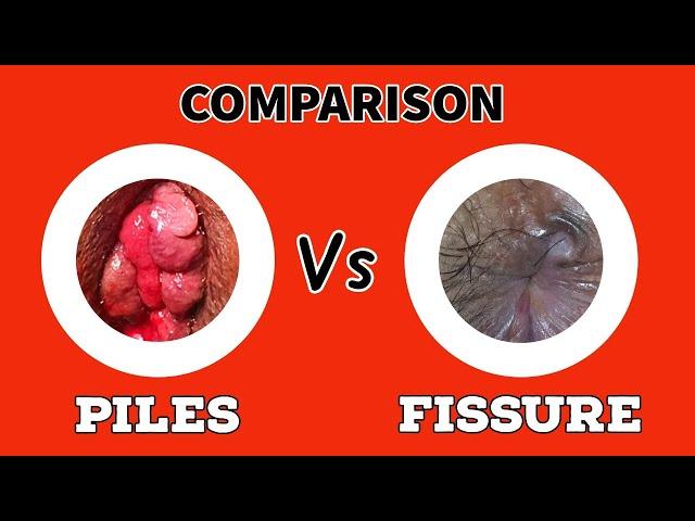 Comparison - PILES Vs FISSURE - ( English Language )