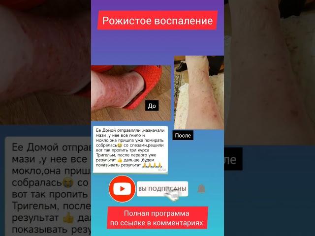Рожистое воспаление