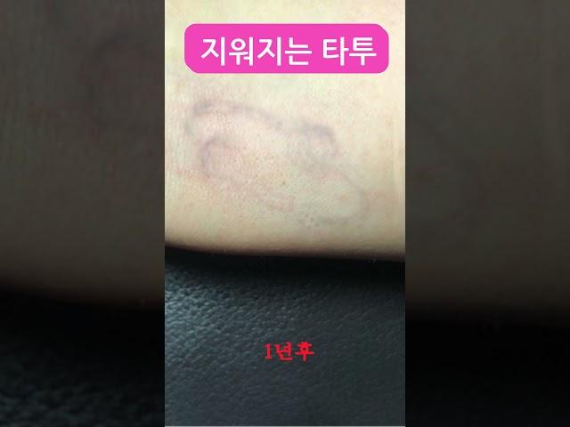 #지워지는타투#타투#스킨타투#대구#대구타투#타투도안#타투디자인#기미#기미제거#기미타투#흉터#흉터커버업#흉터타투#다크서클#다크서클타투#다크서클제거#튼살#튼살제거#튼살커버#튼살타투