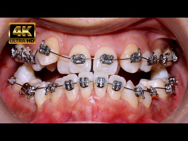 Braces transfomation 4k