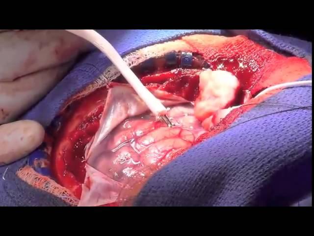 Video Atlas of Neurosurgery 1e: Awake Craniotomy & Speech Mapping for Gliomas