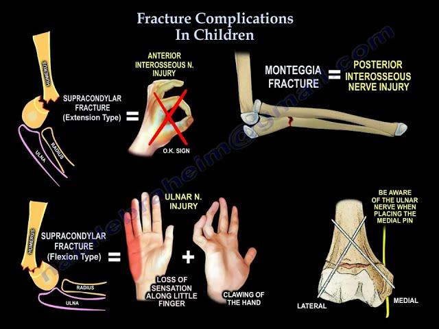 Common Pediatric Fracture Complications.