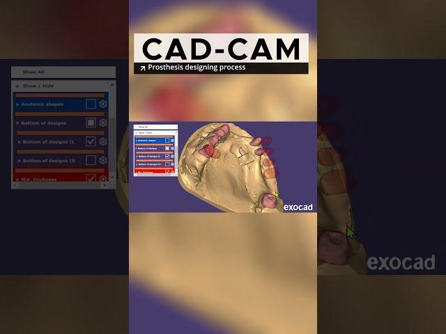 Dental Crowns in Making with CAD-CAM Exocad Software