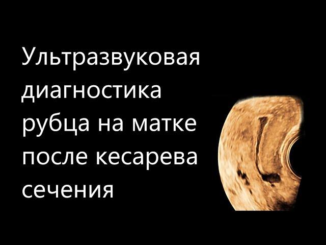 Ультразвуковая диагностика рубца на матке после кесарева сечения