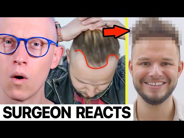 REMARKABLE 6 Months Hair Transplant Before & After | Surgeon Reacts