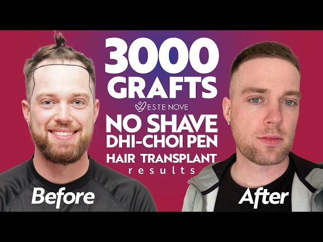 Hair Transplant in Turkey | No Shave DHI with CHOI PEN | 3000 Grafts Before and After