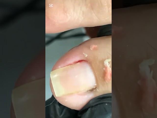 I try to cut both side of nails to clean dry skin