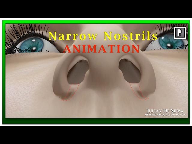 Rhinoplasty Animation - How can Wide Nostrils be Narrowed?