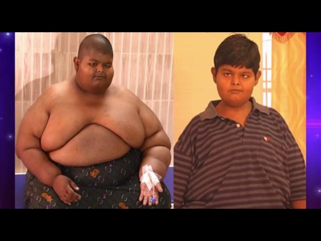 best bariatric surgery results by Dr Ravikanth kongara Hyderabad Vijayawada