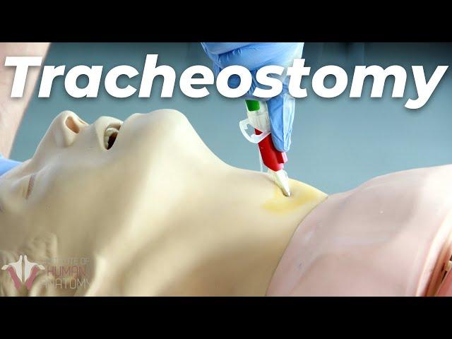 How to Perform a Tracheostomy