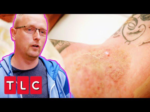 Dr. Emma Treats Painful Skin Condition With A Powerful Laser | The Bad Skin Clinic