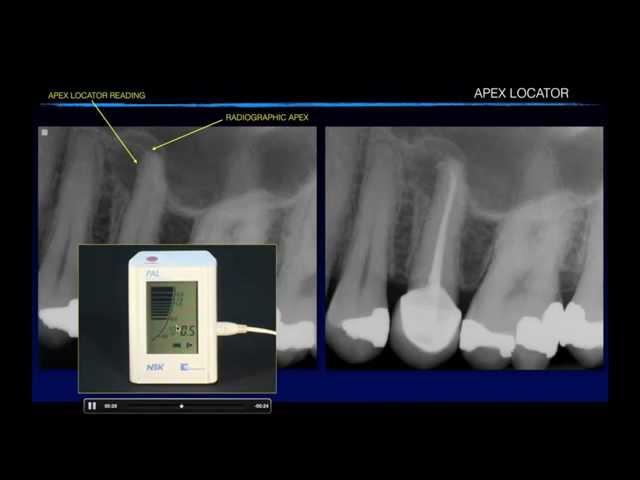 Apex Locator Accuracy: Dr. Alex Fleury Podcast