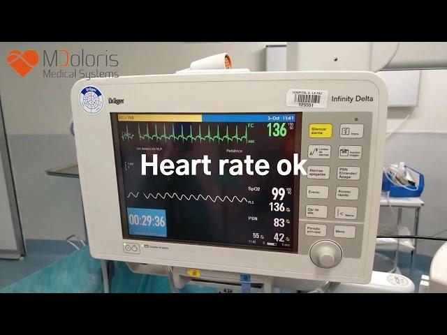 NIPE detects nociception shows the effects of remifentanil bolus in a neonate surgery