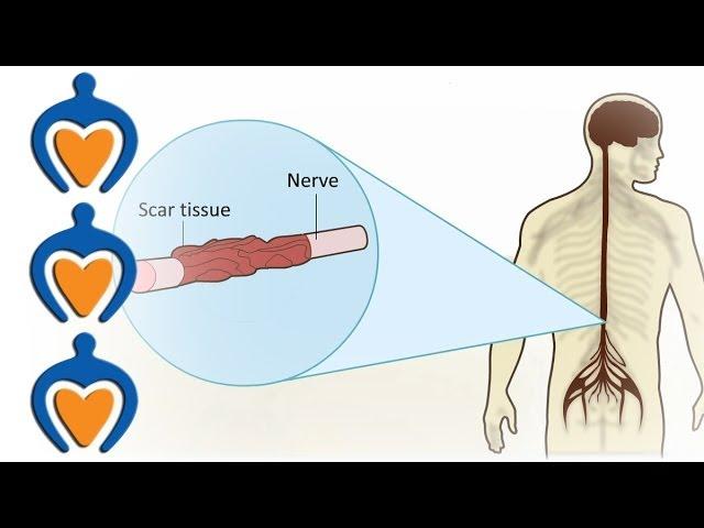 Multiple Sclerosis (MS) - What is multiple sclerosis?