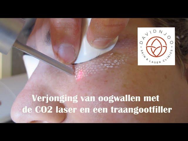 Verjonging van wallen onder de ogen met de CO2 laser en een traangootfiller