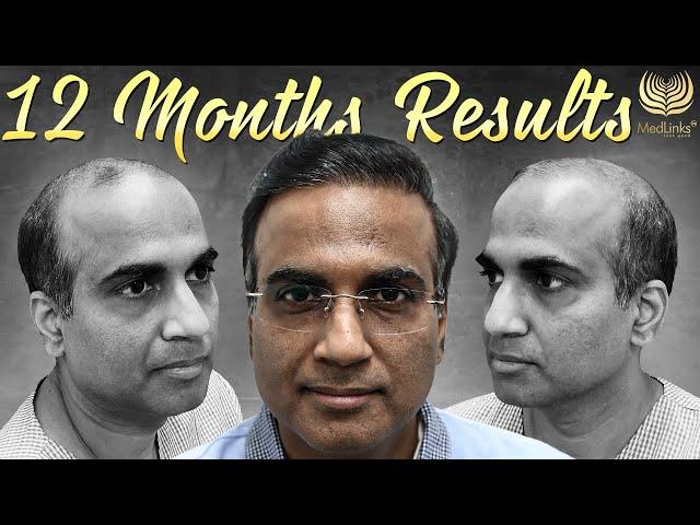 Amazing Transforming Hair Transplant Before and After Results in Grade 6 Baldness (India) | Medlinks