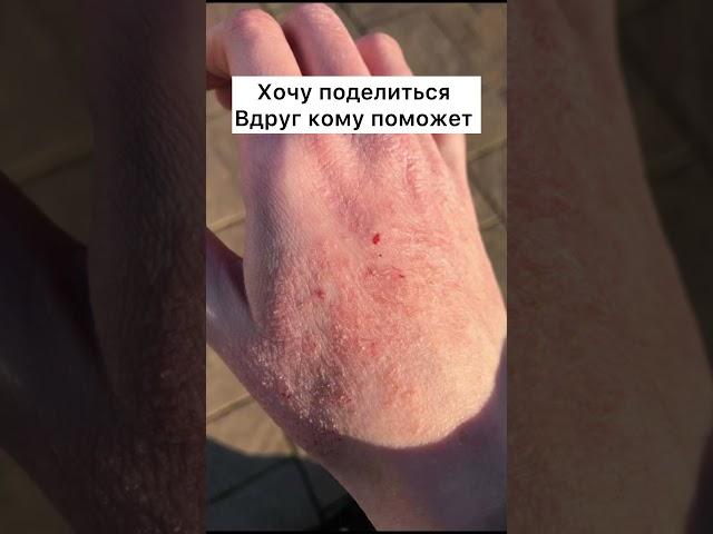 Холодовая аллергия