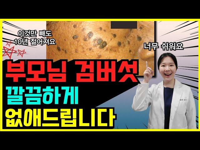 검버섯 싹 없앨 수 있습니다 | 노인성 흑자, 지루각화증 치료방법