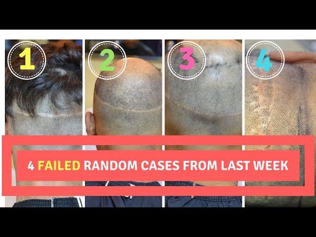 FAILED FUT Hair Transplant Revision with FUE Technique